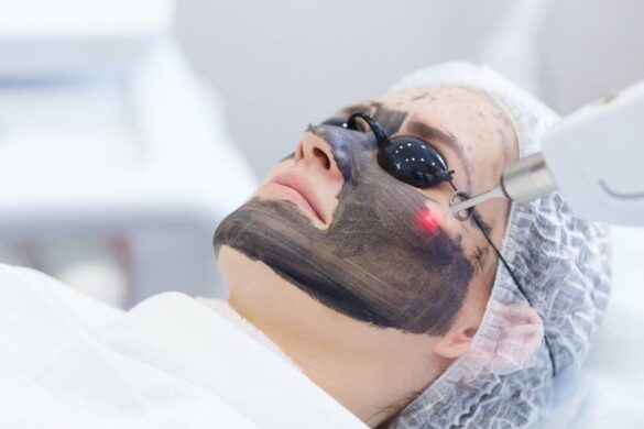 Carbon/Hollywood peel voor een mooie gave huid bij het Laserkabinet in Herentals