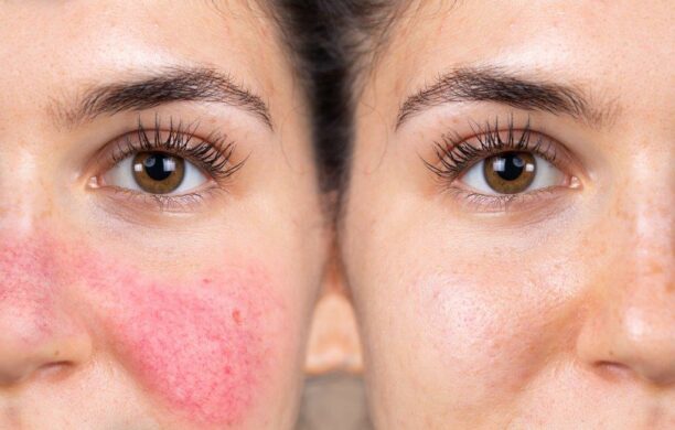 Het Laserkabinet: Rosacea behandelen met lasertherapie en medisch product advies.